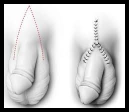 faloplastia edit